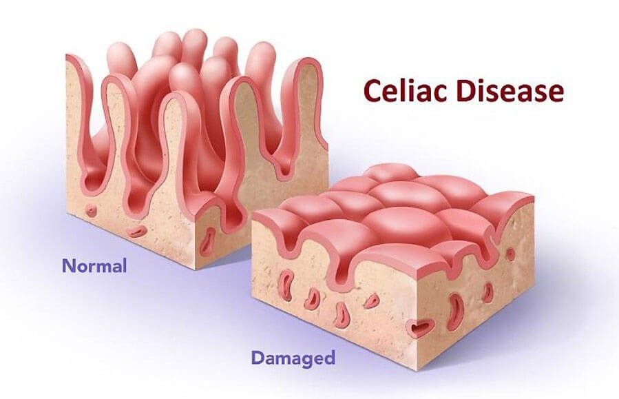 celiac disease treatment pdf free