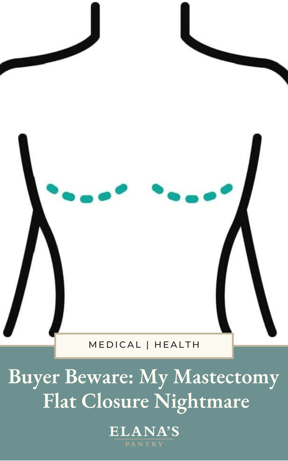 Buyer Beware Mastectomy with Flat Closure Nightmare