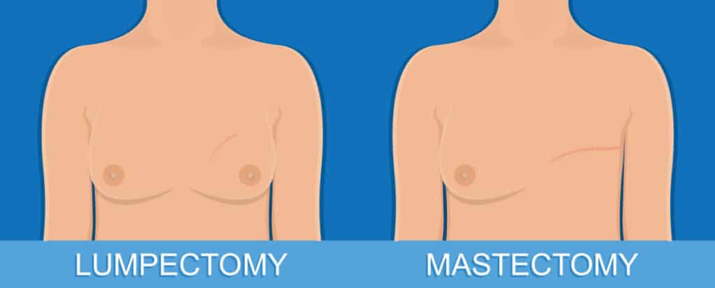 Lumpectomy vs Mastectomy