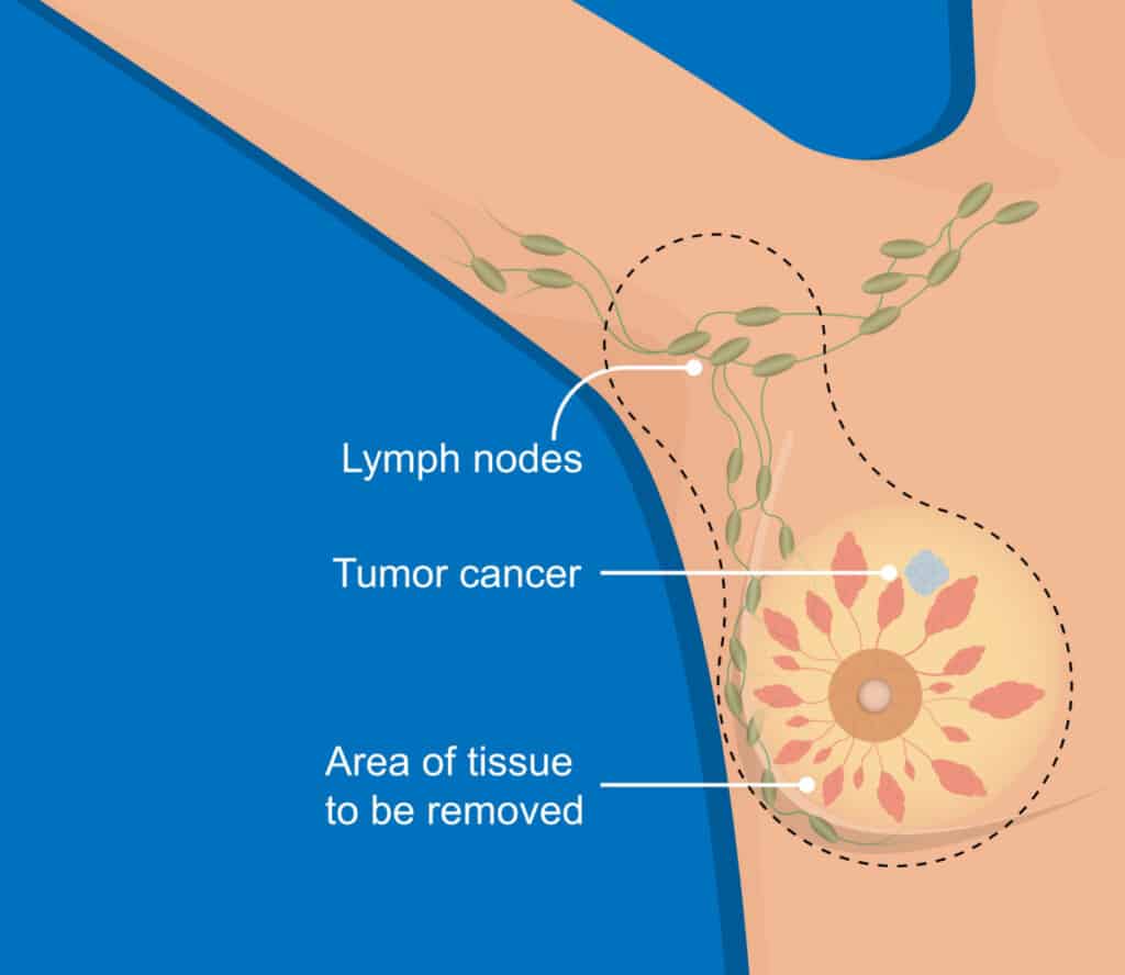 Mastectomy Tissue Removal